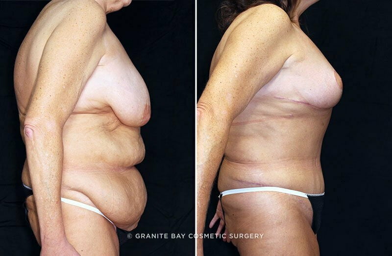 abdominoplasty-breast-lift-19544c-clark