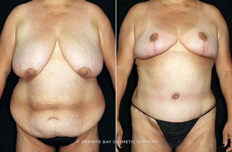abdominoplasty-liposuction-breast-lift-18731a-clark