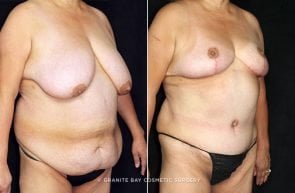 abdominoplasty-liposuction-breast-lift-18731b-clark