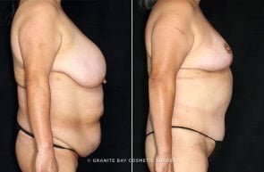 abdominoplasty-liposuction-breast-lift-18731c-clark
