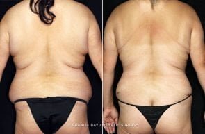 abdominoplasty-liposuction-breast-lift-18731d-clark