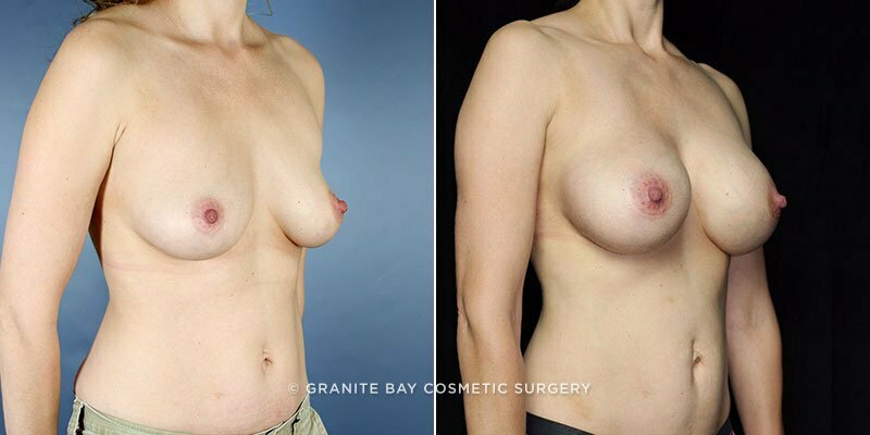 breast-augmentation-11012b-clark