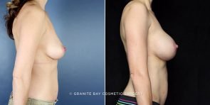 breast-augmentation-11012c-clark