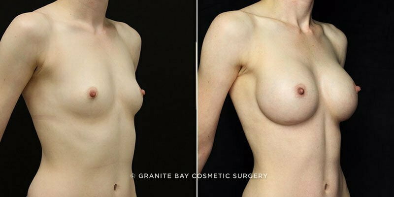 breast-augmentation-12b-clark