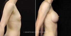 breast-augmentation-12c-clark