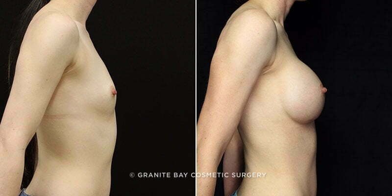 breast-augmentation-12c-clark