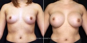 breast-augmentation-17720a-clark