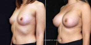 breast-augmentation-17720b-clark