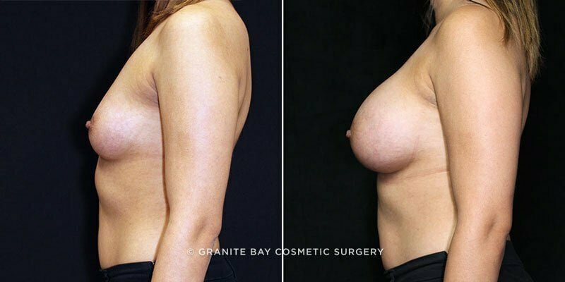 breast-augmentation-17720c-clark
