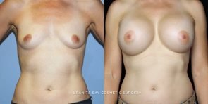 breast-augmentation-18339a-clark