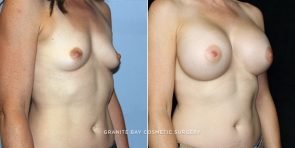 breast-augmentation-18339b-clark