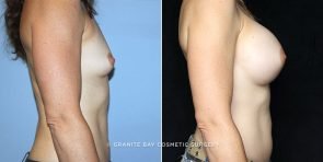 breast-augmentation-18339c-clark