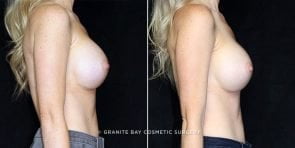 breast-augmentation-18390c-clark