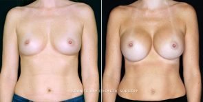 breast-augmentation-19527a-clark