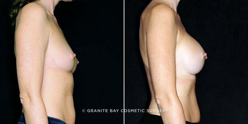 breast-augmentation-19527c-clark