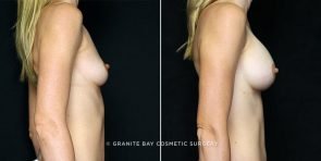 breast-augmentation-19551c-clark