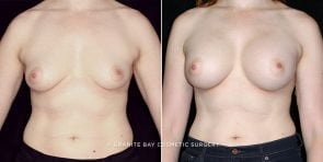 breast-augmentation-19566a-clark