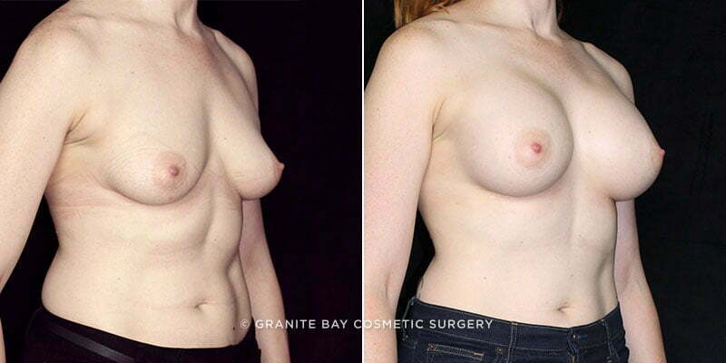 breast-augmentation-19566b-clark