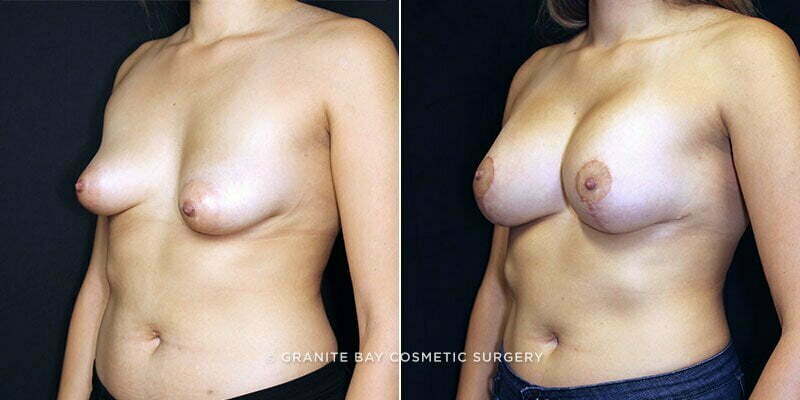 breast-lift-with-augmentation-19547b-clark