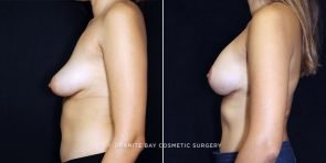 breast-lift-with-augmentation-19547c-clark