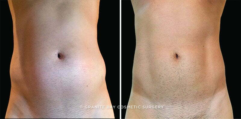 CoolSculpting