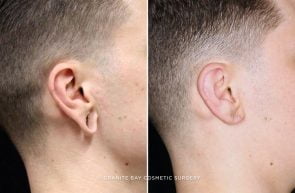 earlobe-repair-19508c-clark-close-up