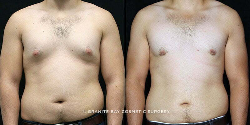 Male Breast Reduction