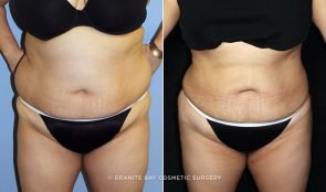Liposuction with Fat Transfer to Buttocks