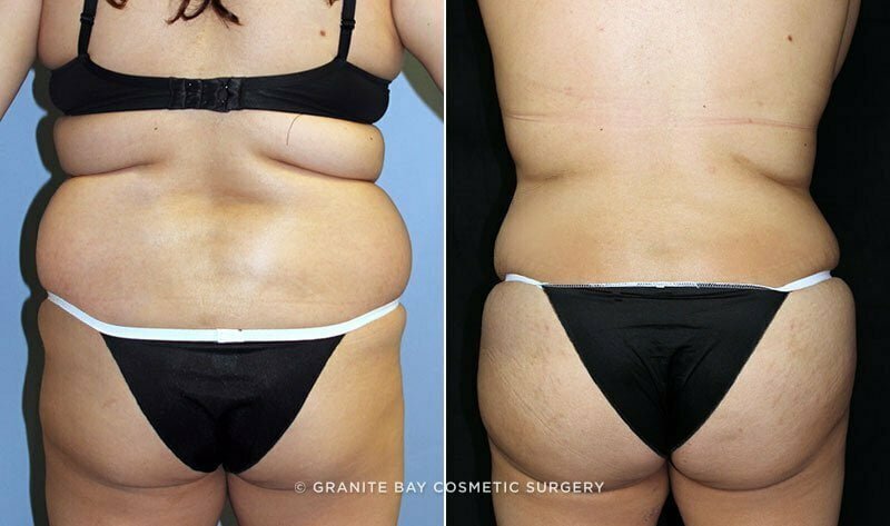liposuction-fat-transfer-18008d-clark
