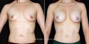 breast-augmentation-19525a-clark
