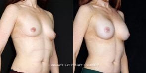 breast-augmentation-19525b-clark