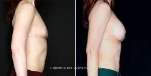 breast-augmentation-19525c-clark