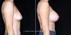 breast-augmentation-19534c-clark