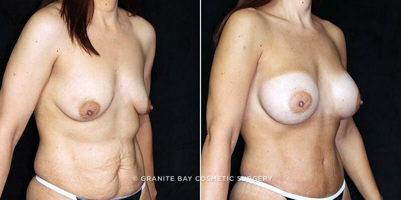 breast-augmentation-tt-19775b-clark