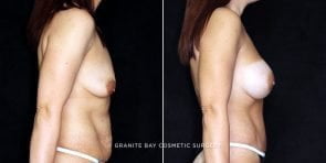breast-augmentation-tt-19775c-clark