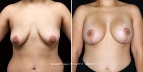 breast-lift-with-augmentation-19596a-clark