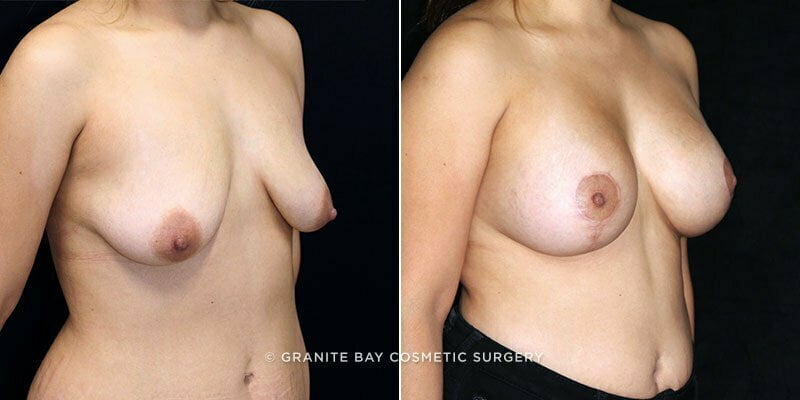 breast-lift-with-augmentation-19596b-clark