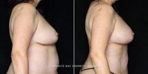 fat-trans-breasts-liposuction-20257-clark