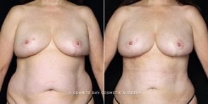 fat-trans-breasts-liposuction-20257a-clark
