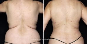 fat-trans-breasts-liposuction-20257d-clark
