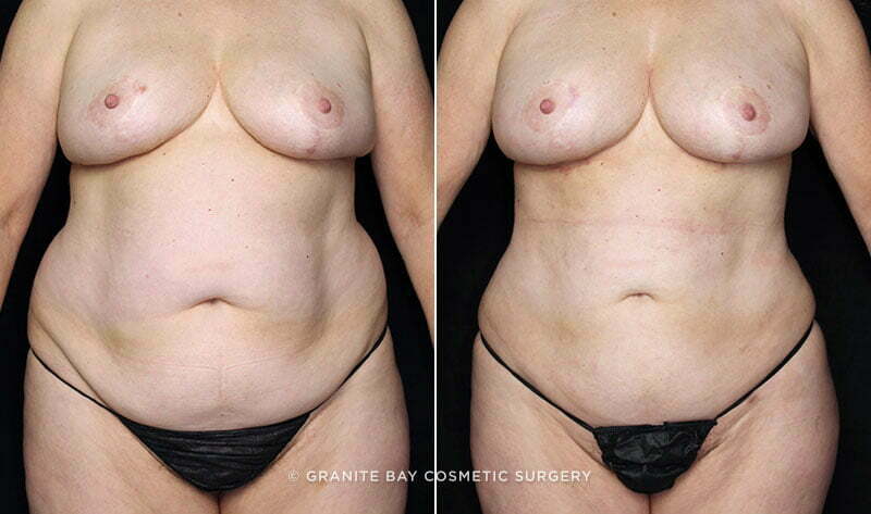 liposuction-flanks-bra-rolls-fat-trans-BA-20257a-clark