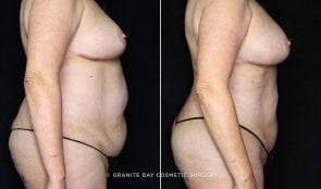 liposuction-flanks-bra-rolls-fat-trans-BA-20257c-clark