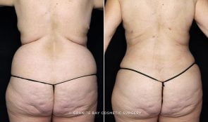 liposuction-flanks-bra-rolls-fat-trans-BA-20257d-clark