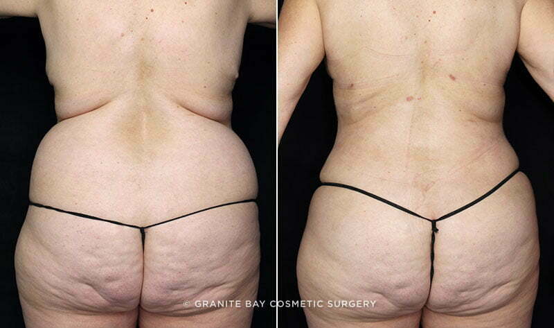liposuction-flanks-bra-rolls-fat-trans-BA-20257d-clark