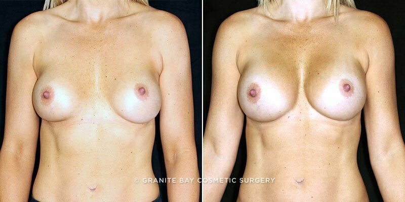 revision-breast-augmentation-19662a-clark