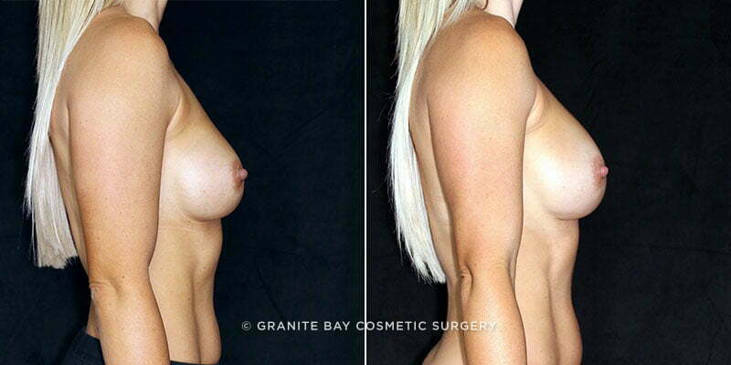 revision-breast-augmentation-19662c-clark