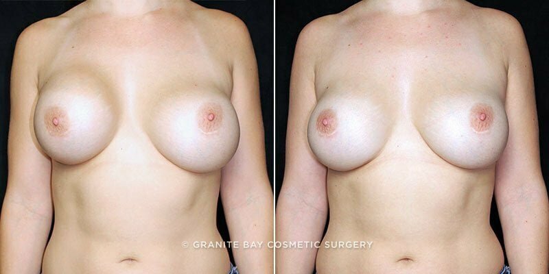 revision-breast-augmentation-20117a-clark
