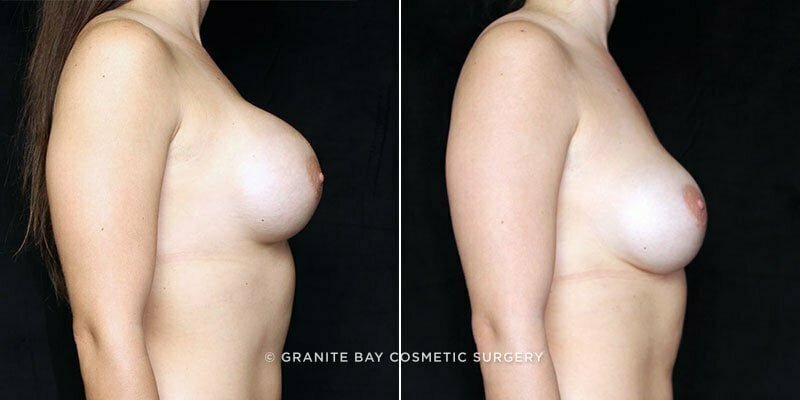 revision-breast-augmentation-20117c-clark