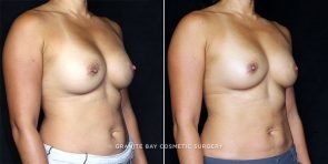 revision-breast-implant-exchange-19975b-clark
