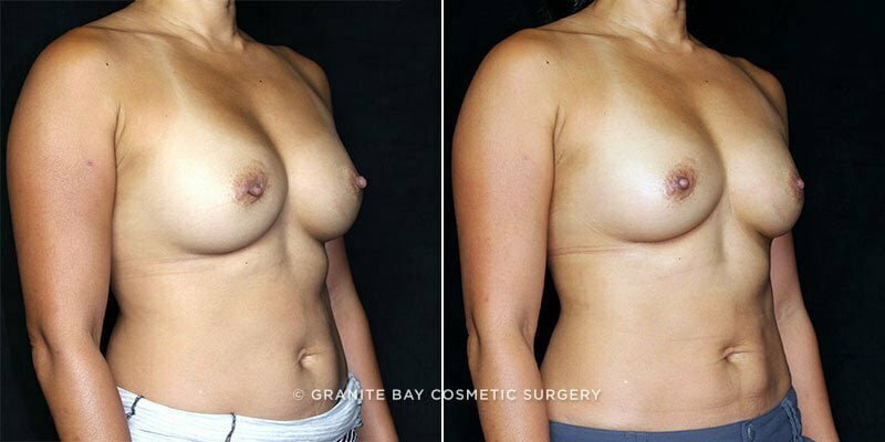 revision-breast-implant-exchange-19975b-clark